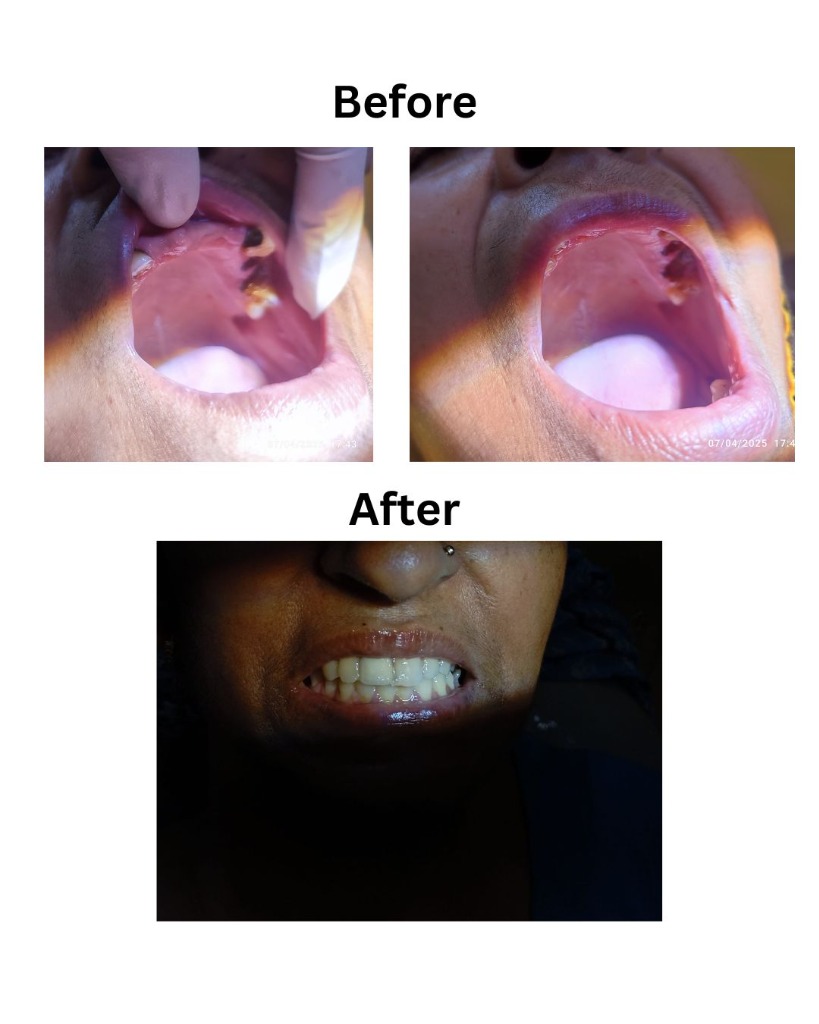 Complete Denture - Before and After