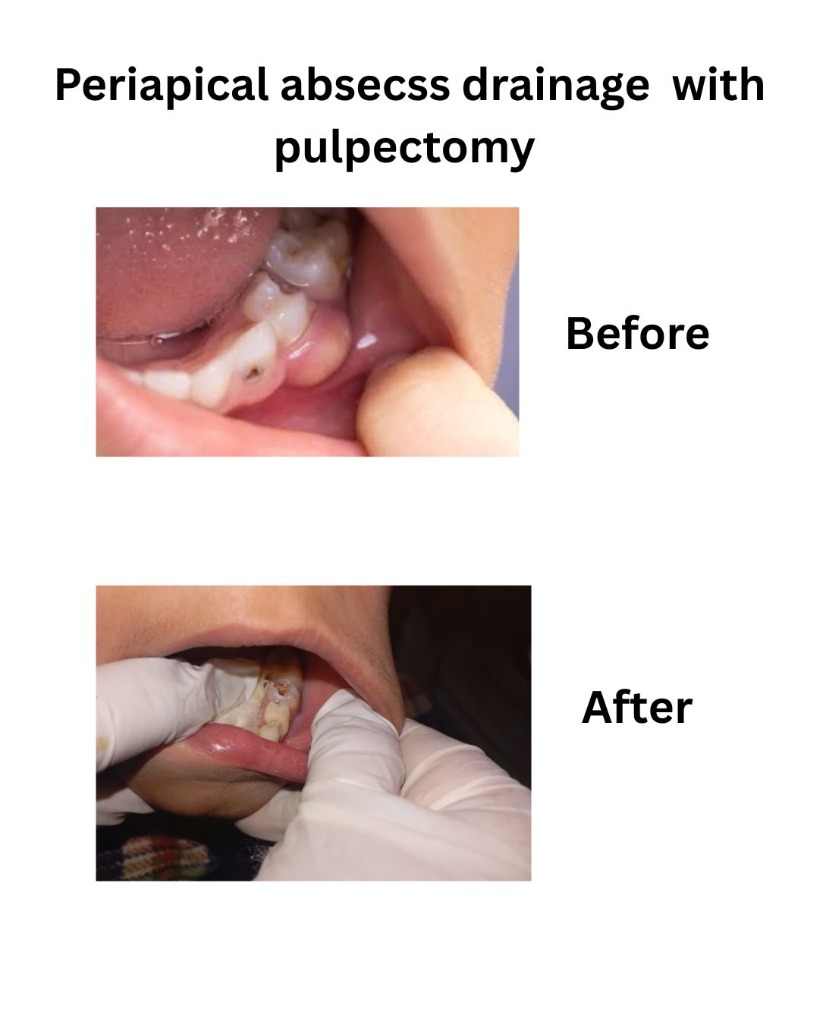 Abscess Treatment - Before and After