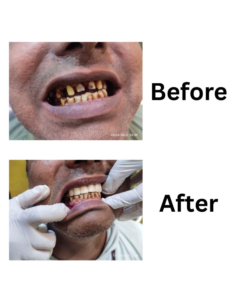 Full Mouth Rehabilitation - Before and After