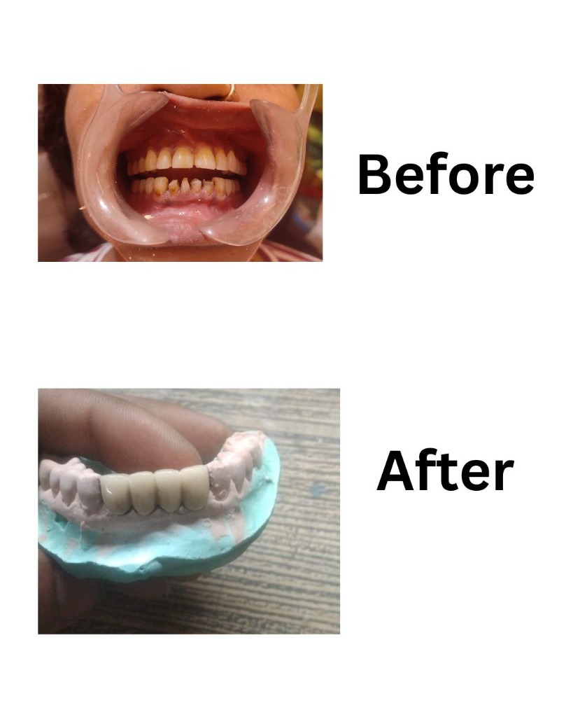 Fixed Bridge - Before and After