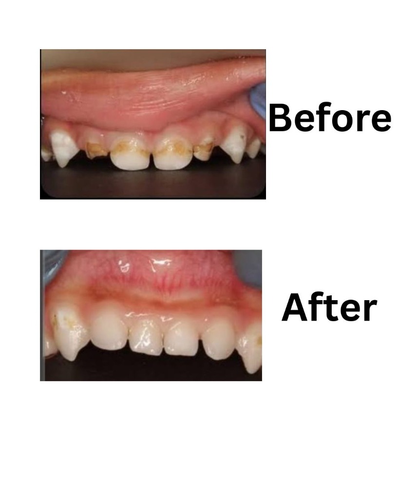 Children Treatment - Before and After